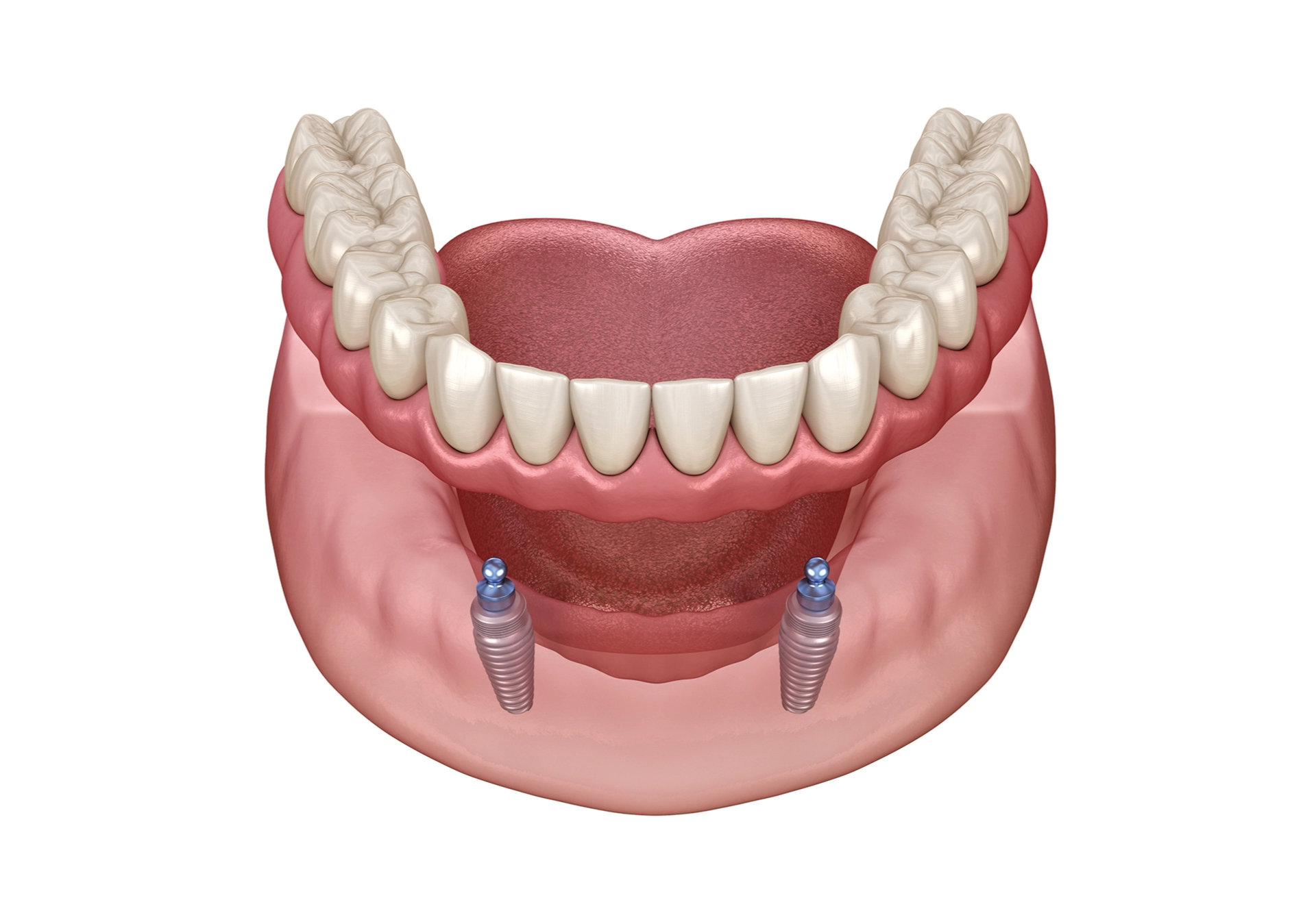 overdentures