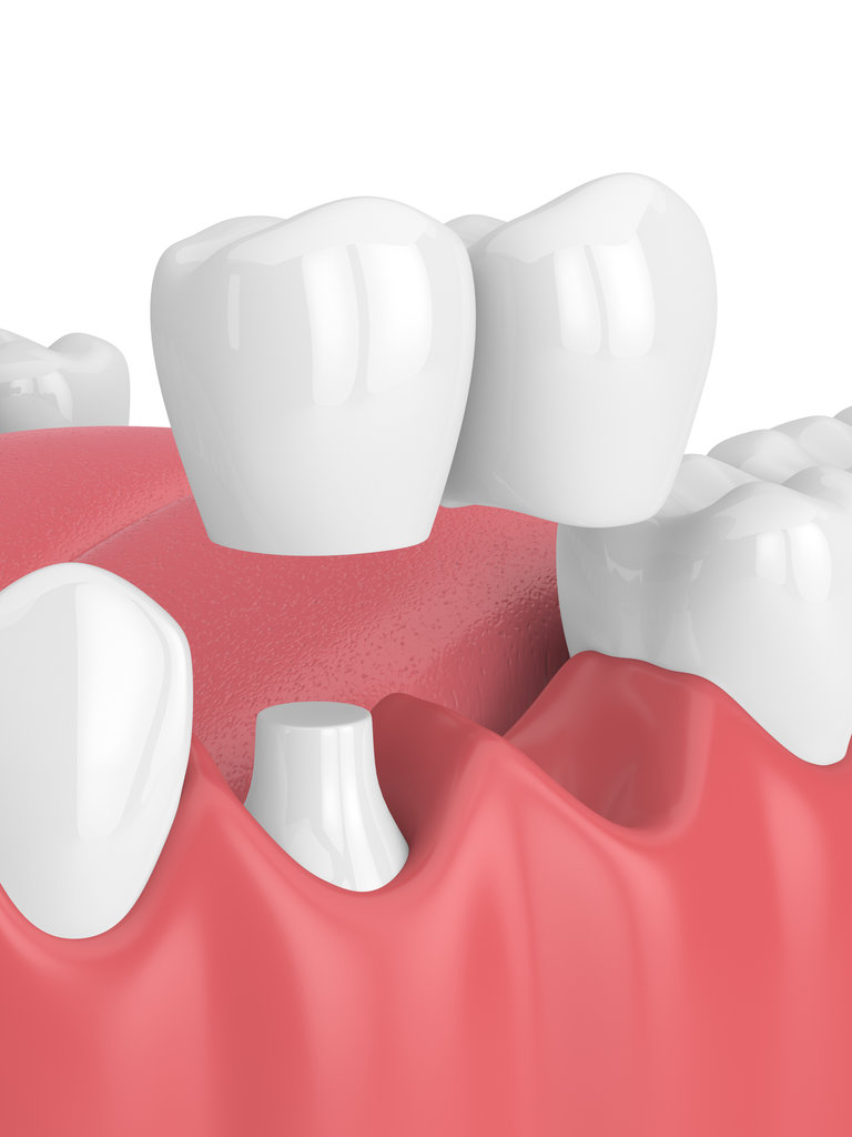 3d render of jaw with dental cantilever bridge
