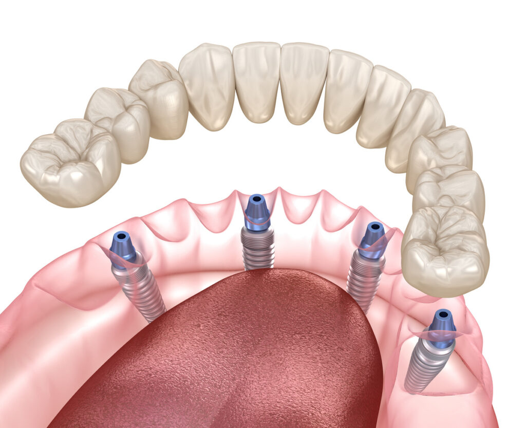 Mandibular prosthesis All on 4 system supported by implants. Medically accurate 3D illustration of human teeth and dentures concept