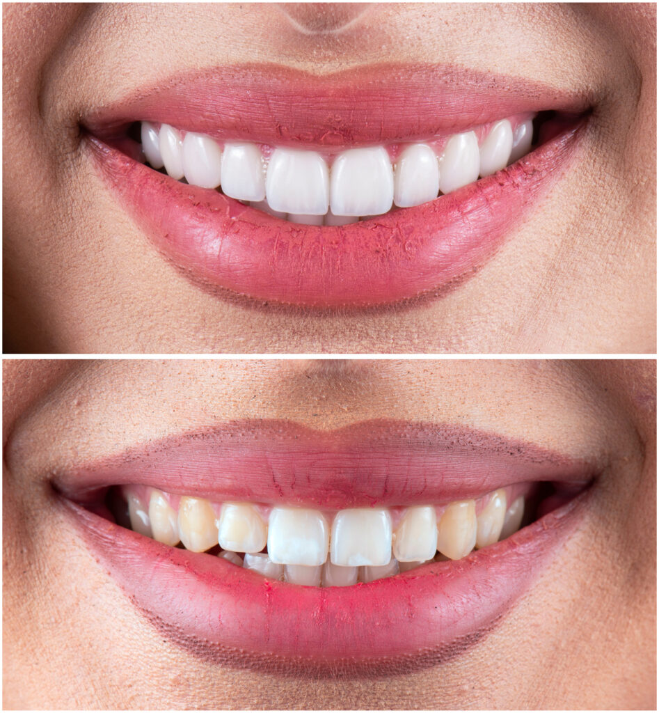 before and after picture of ceramic restorations on teeth by emax and zirkon crowns and veneers