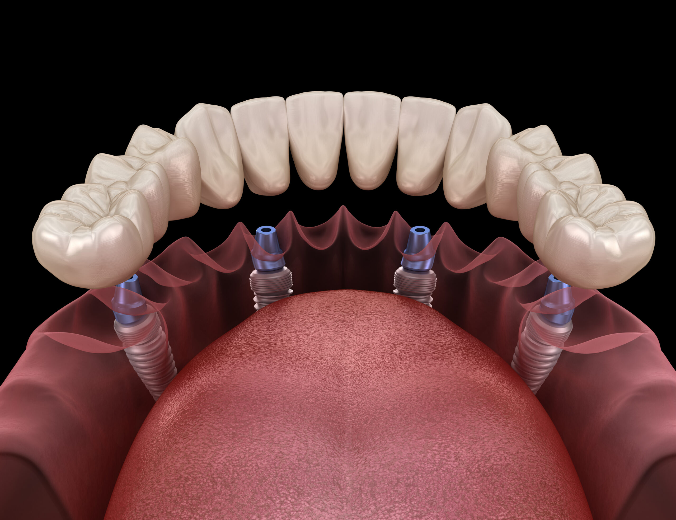 Dental prosthesis based on 4 implants. Dental 3D illustration