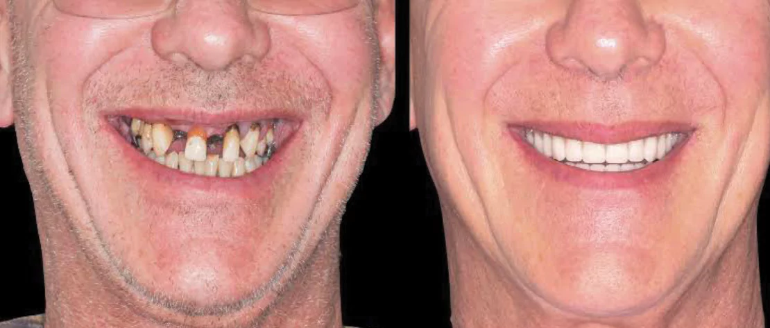 tooth-loss