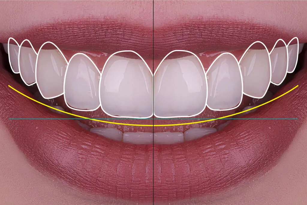 Smile design treatment and smile makeover