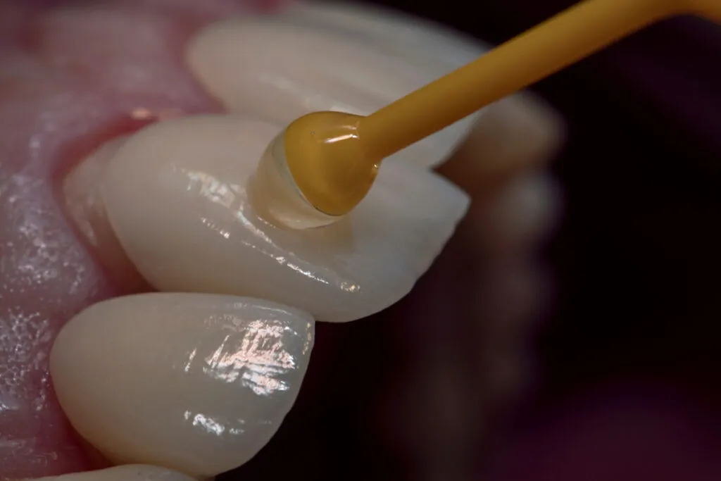 Porcelain veneers dentaal design