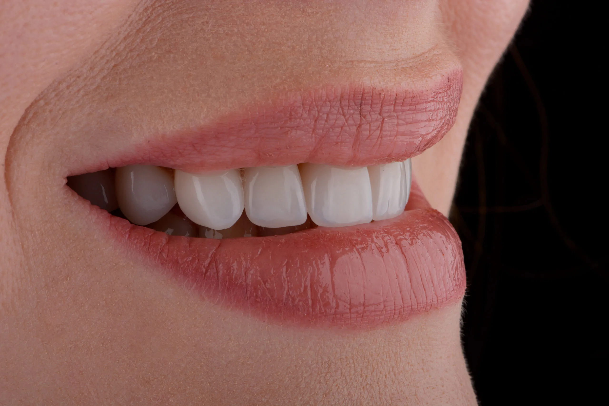 Female smile makeover by dental ceramic veneer, porcelain laminate veneers. Dental zirkonia crowns on upper jaw.